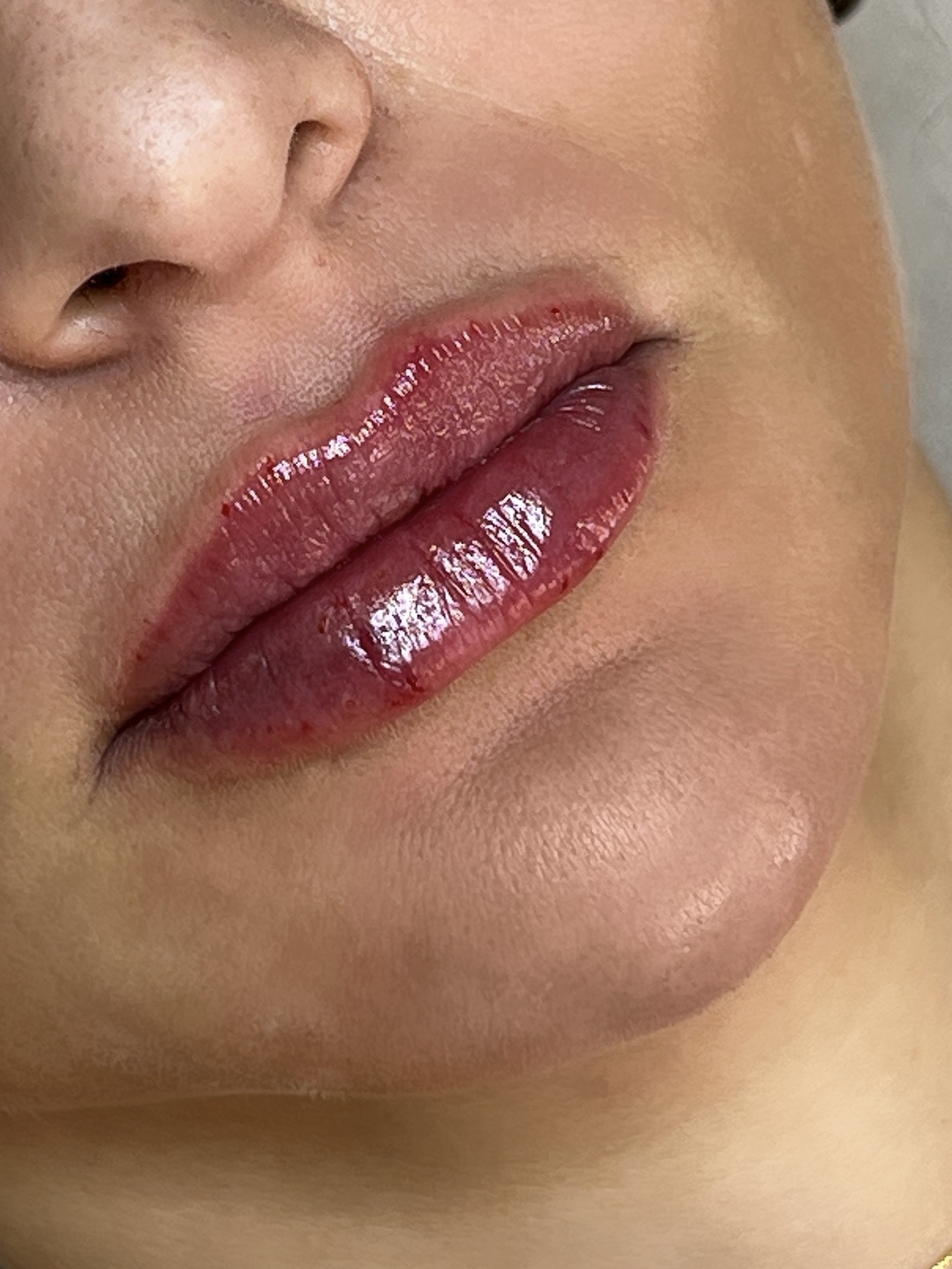 Luana depois do preenchimento labial
